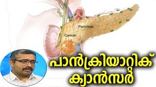 Dr Q: പാന്‍ക്രിയാറ്റിക് ക്യാന്‍സര്‍ | Pancreatic Cancer  | 25th February 2019