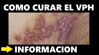 Como Curar el VPH: Tratamiento Papiloma Humano, Cura VPH Naturalmente