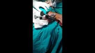OSTEOSÍNTESIS DE TIBIA CON CLAVO BLOQUEADO