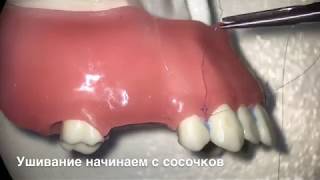 Открытый синус лифтинг