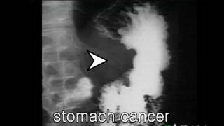 Stomach Cancer: An Overview | Los Angeles Endoscopy