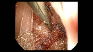 uterine prolapse in young women