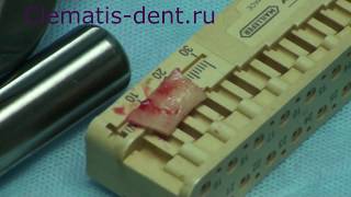 Операция удаления ранее установленных дентальных имплантатов в области 31,42 зубов.