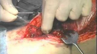 Остеомиелит бедренной кости -  osteomielit femur