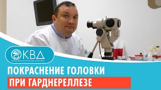 Покраснение головки при гарднереллезе. Клинический случай №50