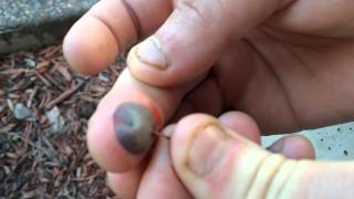 Popping a blood blister: Warning GROSS