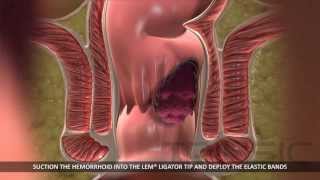 Латексное лигирование геморроидальных узлов/Rubber Band Hemorrhoid Ligation