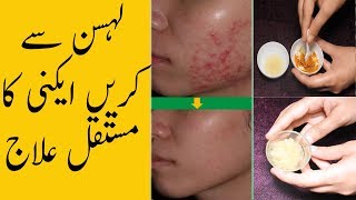 Garlic For Acne | Lehsan Se Chehray Ky Dano Ka Ilaj | Get Rid Of Acne, Pimples