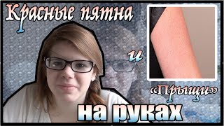 Красные пятна и "прыщи" на руках? / Куриная кожа (chicken skin)