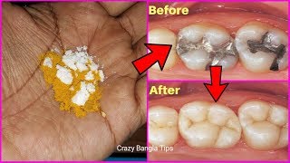 দুর্বল ও হলুদ দাঁতকে লোহার মতো শক্ত ও ঝকঝকে সাদা করার উপায়।How To Get Whitening Teeth At Home