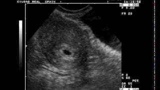 Aborto diferido de 5 semanas  Dr. Rafael Ortega Muñoz Ciudad Real