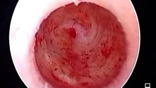 Laparoscopic removal of Rudimentary , Non Communicating uterine horn
