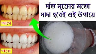 হলুদ বা কষ পড়ে যাওয়া দাঁত মুক্তোর মতো সাদা করুন মাত্র ৩ মিনিটে এই ঘরোয়া উপায়ে..