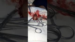 কিভাবে মুসলমানি করা হয় পর্ব 3
