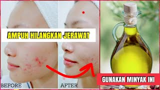 Manfaat Minyak Zaitun Untuk Kulit Wajah Berjerawat dan Kecantikan