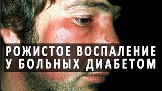 Рожистое воспаление (рожа) у больных сахарным диабетом