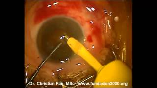 Cataract Surgery - Facoemulsificacion - Megatron S4 - Geuder