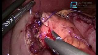 Laparoscopic Whipple´s  Procedure