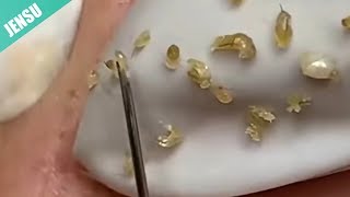 Milia - Big Blackheads - Pimple - Ance - にきび - にきび [HD] #24