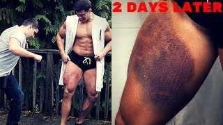 Punched 100 Times in the SAME SPOT Experiment *Crazy Bruising* | Painful Punch Damage Test VS My Leg