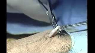 No-Scalpel Vasectomy  by Dr. Marc Goldstein & Dr. Philip S. Li