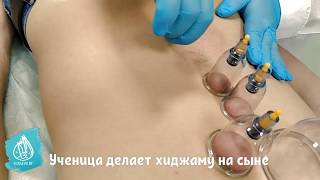 Хиджама практика учеников. Семинар по хиджаме