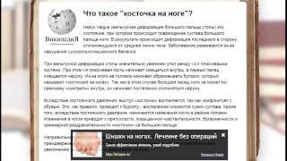 накладки на косточки на ногах