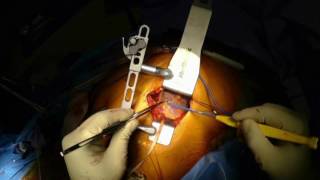 Off pump MICS CABG with BITAvia left small thoracotomy under direct vision 2016 12 24 2
