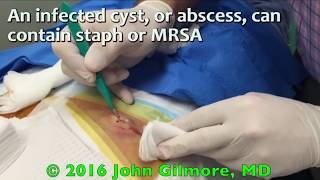 Most Popular Cysts Of All Time!