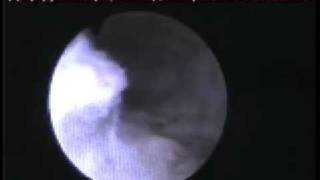 Седловидная матка+эндометриоз Г361 2005