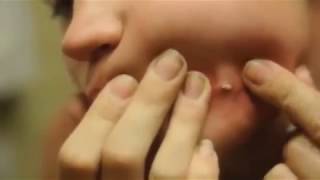 ШООК БОЛЬШОЙ ЧИРЕЙ/БОЛЬШОЙ ЧИРЯК/БОЛЬШОЙ ПРЫЩ/БОЛЬШОЙ ГНОЙНИК\МНОГО ГНОЯ