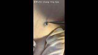 深層黑頭 Deep DPOW extraction - 澄熒SPA