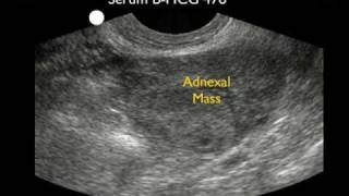 Ectopic Pregnancy Case Study - Part 2
