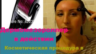 Дермомезороллер в действии .Косметическая процедура в домашних условиях