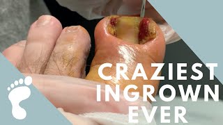 WE'RE THANKFUL FOR THIS EPIC INGROWN | HAPPY THANKSGIVING Y'ALL