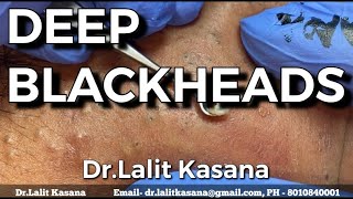DEEP OLD BLACKHEADS REMOVAL BY Dr.Lalit Kasana (24 Jan. 2020)