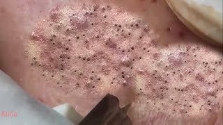 ОГРОМНЫЕ СОЧНЫЕ ЧЕРНЫЕ ТОЧКИ НА ЛИЦЕ | ЧИСТКА БОЛЬШИХ УГРЕЙ