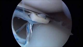 Knee Arthroscopy from Chatswood NSW Knee Surgeon, Dr.Brett Fritsch
