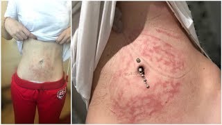 ♡ WARNING: To Anyone Who Uses a Heat Pack!! (Erythema ab igne) | Amy's Life ♡
