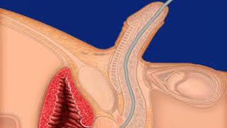 Penile Urinary Catheter Insertion Procedure