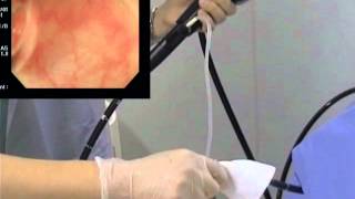 Colonoscopy, water immersion method 大腸内視鏡　水浸法