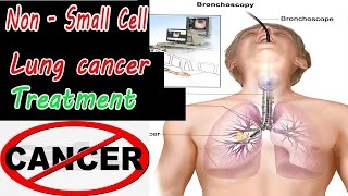 Lung cancer: Non Small Cell Lung cancer Treatment ???
