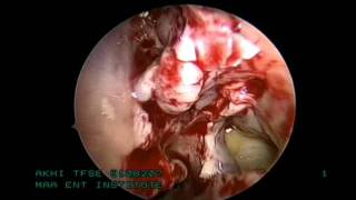 Endoscopic Sinus Surgery -  MAA ENT Hospitals