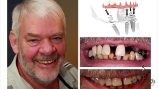 нет зубов - адентия: протезирование all in 4 implants ФАБЕРЖЕ