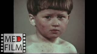 Аллергодерматозы у детей © Allergomatosis in children