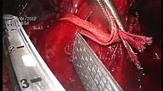 Полностью торакоскопическая левосторонняя верхняя лобэктомия при I стадии НМРЛ