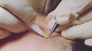 Electrolysis San Diego | Permanent Hair Removal (619) 243-8733