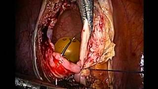 Bladder Endometriosis .