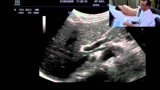 ULTRASOUND EXAMINATION OF THE ABDOMEN