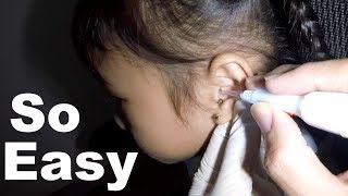 Removing Little Girl's Early Earwax Blockage